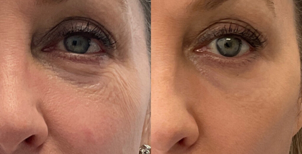Micro RF on the undereye to promote collagen