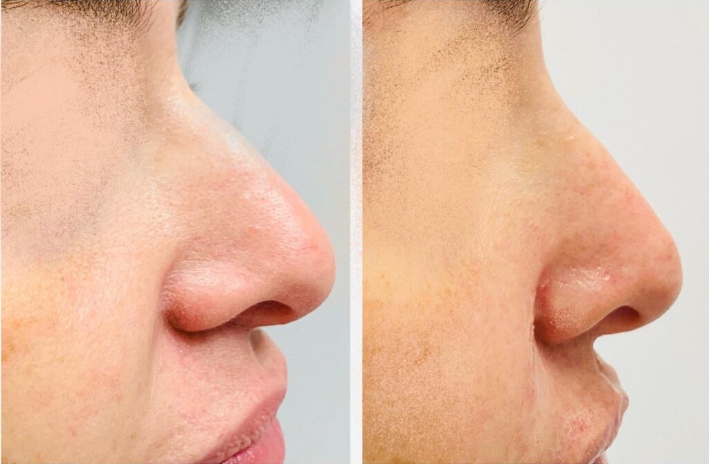 Side-by-side before-and-after profile photos showing the nose from the side, with a smoother and more balanced contour in the after image. Simply Dermatology logo appears above the photos.