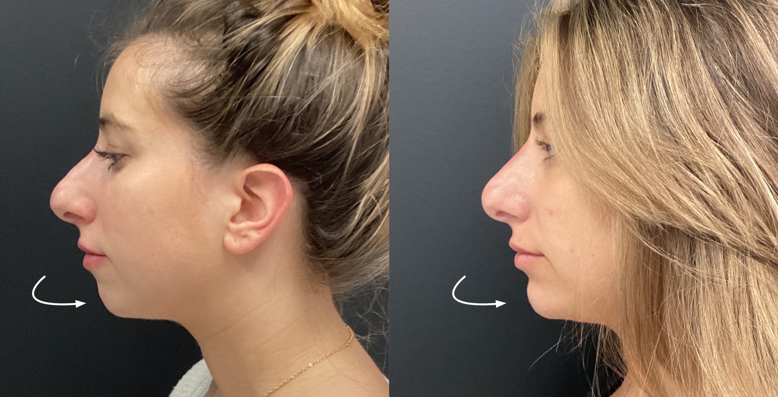 Nose and Chin Filler before and after