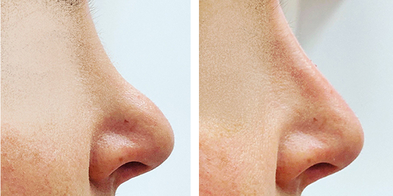 Before and After: Nose Filler