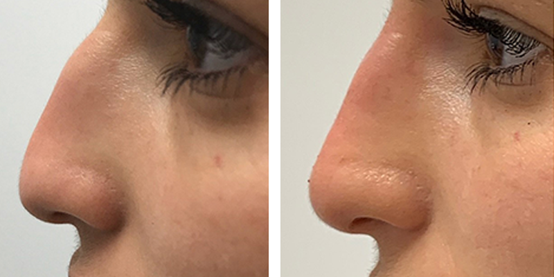 Before and After: Nonsurgical Rhinoplasty