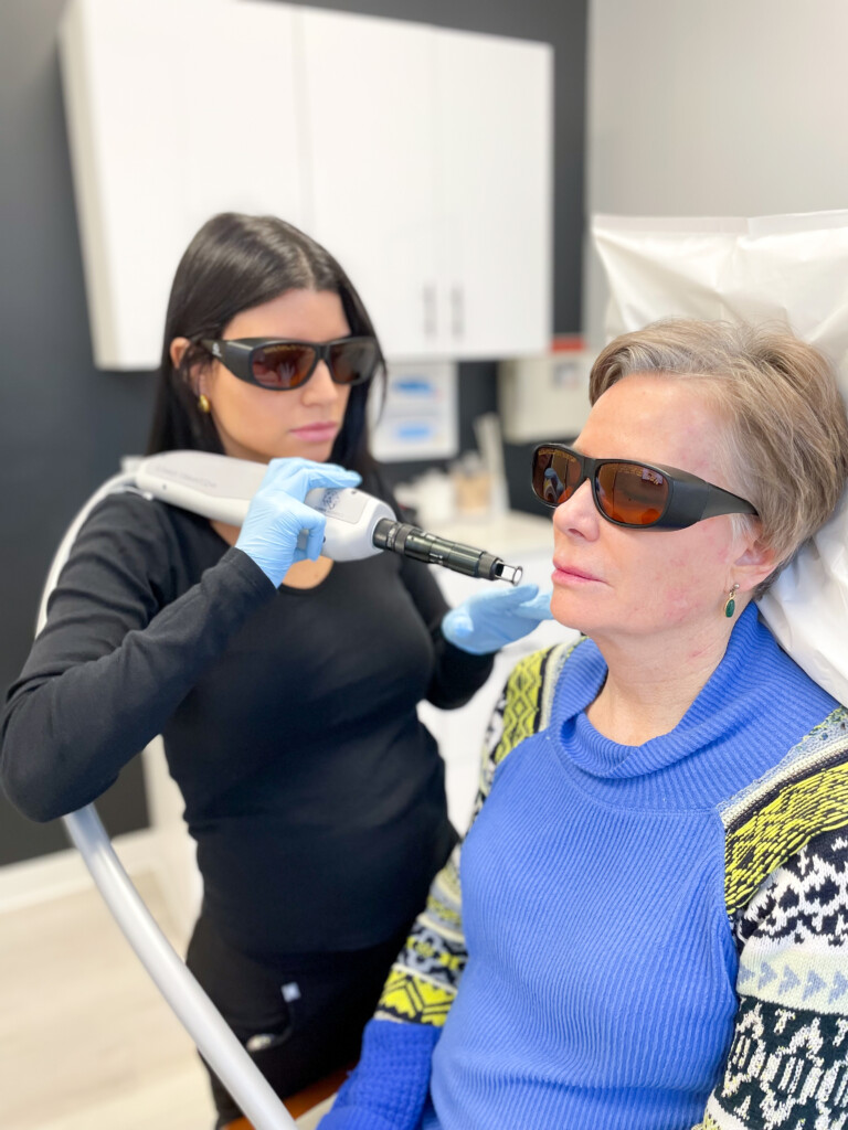 Q-Switch laser treatment being performed on a patient’s face at Simply Dermatology in Melville, Long Island, with both patient and provider wearing protective eyewear.