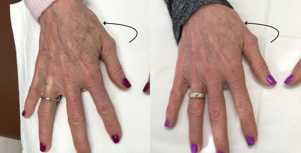 Q switch for brown spots on patient's ahnds