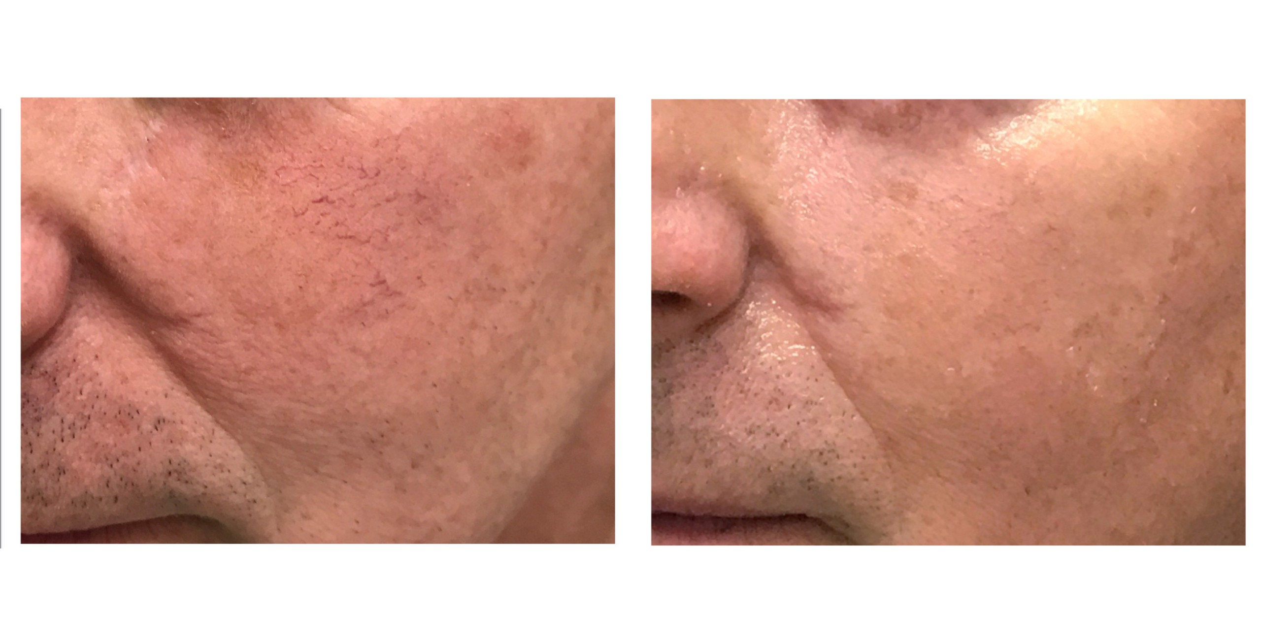 Before and After: Redness and Vessels