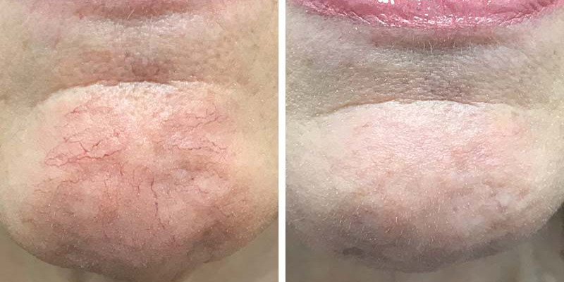 Before and After: Vein Laser