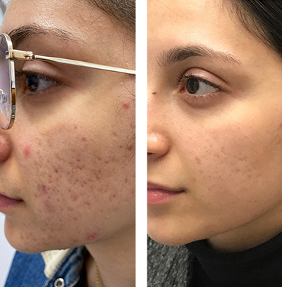 Complexion Wrinkles, Pores and Acne Scars Procedure Results