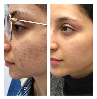 Complexion Wrinkles, Pores and Acne Scars Procedure Results
