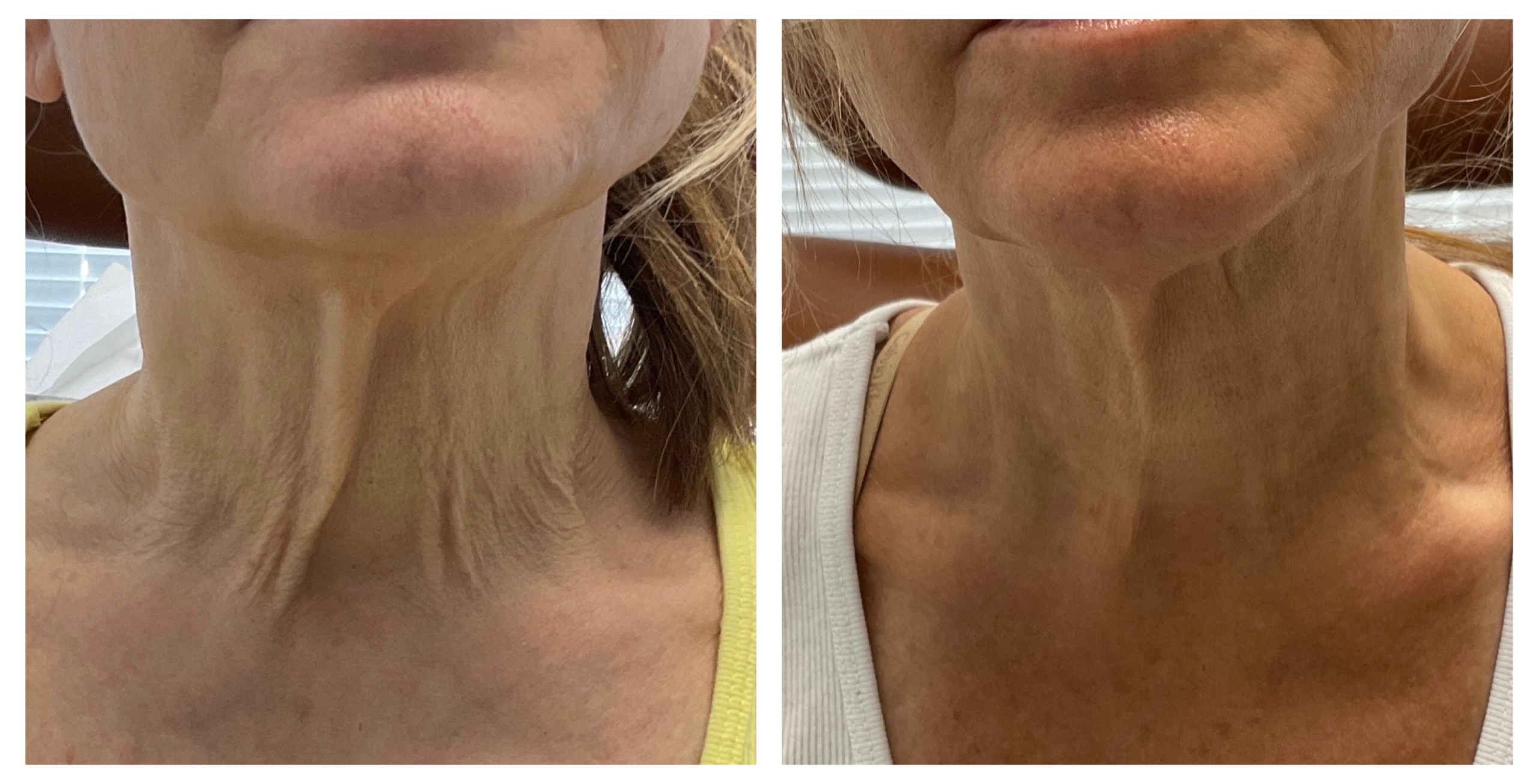 Before and After: Skin Tightening