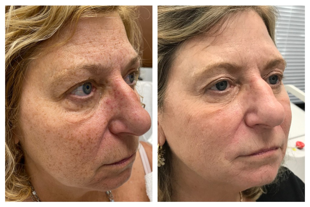 Before and After q switch fraxel stack and save in November cosmetic treatments
