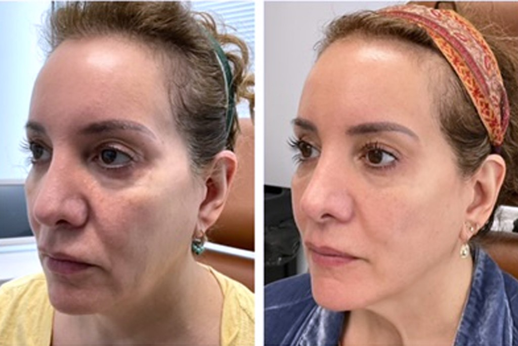 Before and After Ulthera stack and save in November cosmetic treatments