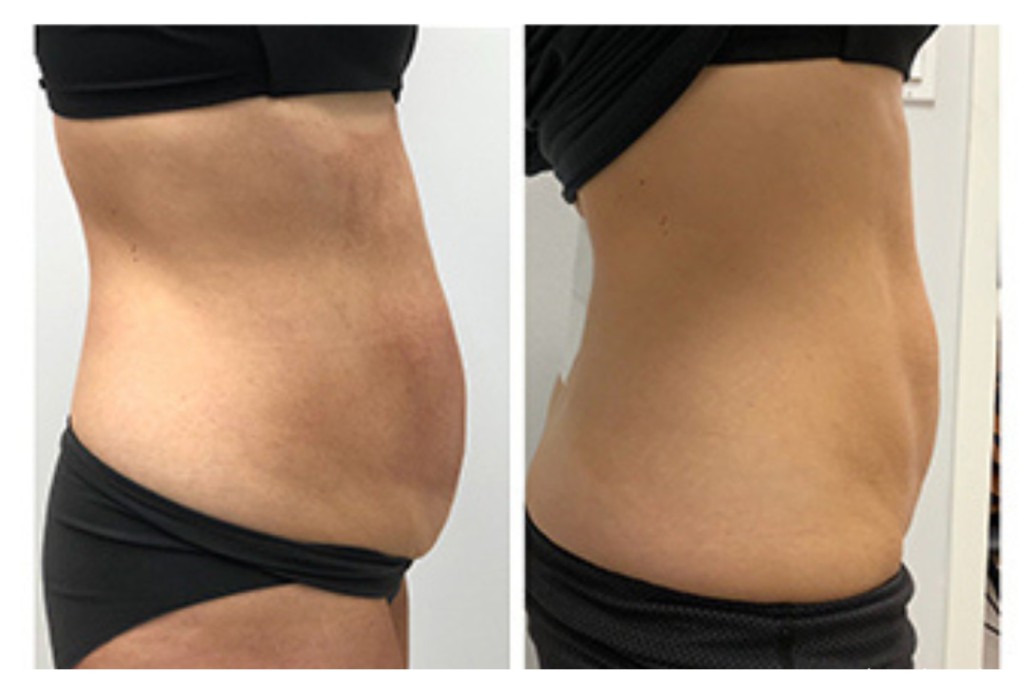 Before and After Ultrashape stack and save in November cosmetic treatments