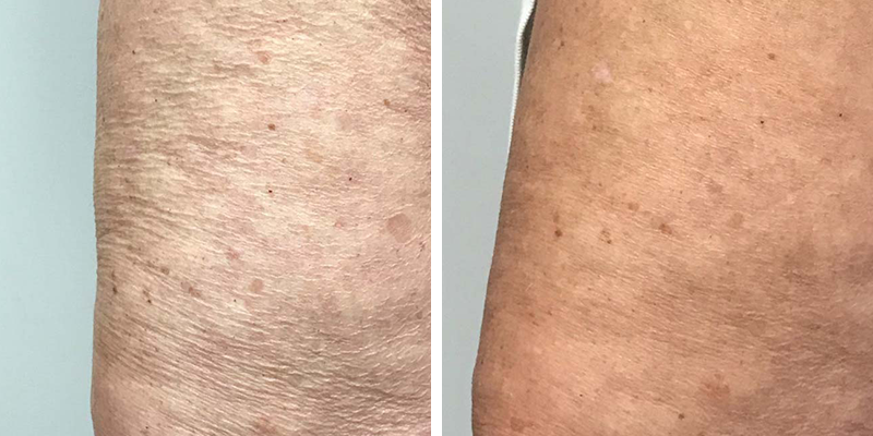 Body Contouring Cellulite Treatment Results
