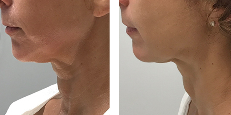 Before and After: Ultherapy on Neck