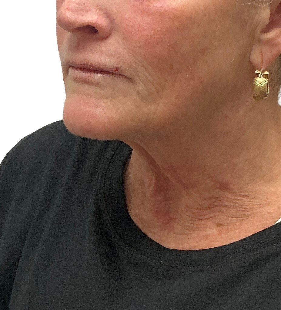 Before Ultherapy treatment showing skin laxity and lines along the lower face and neck