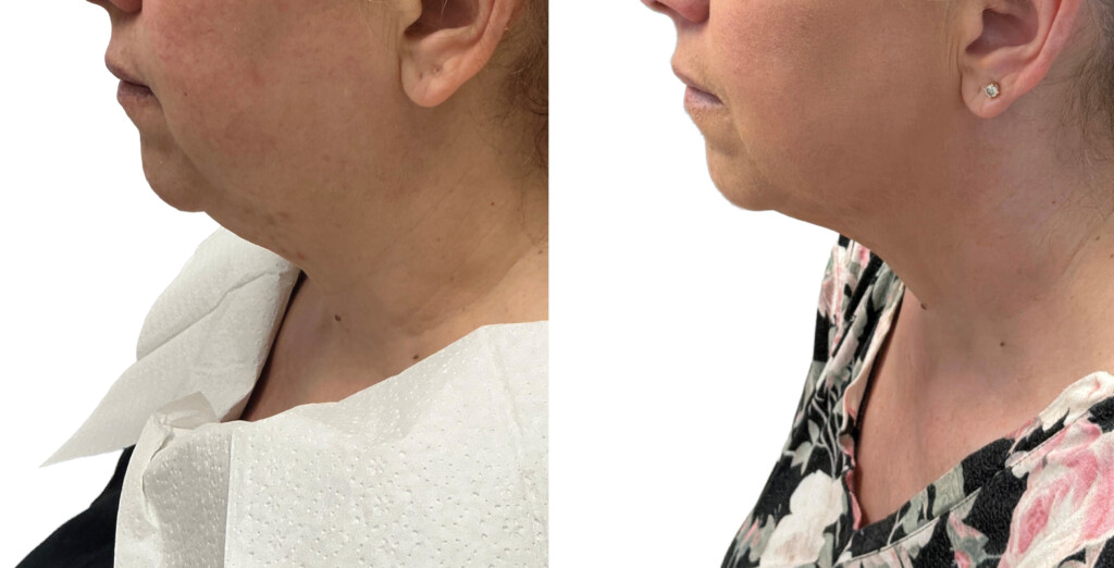 Ultherapy Prime before and after showing improvement in neck and jawline laxity