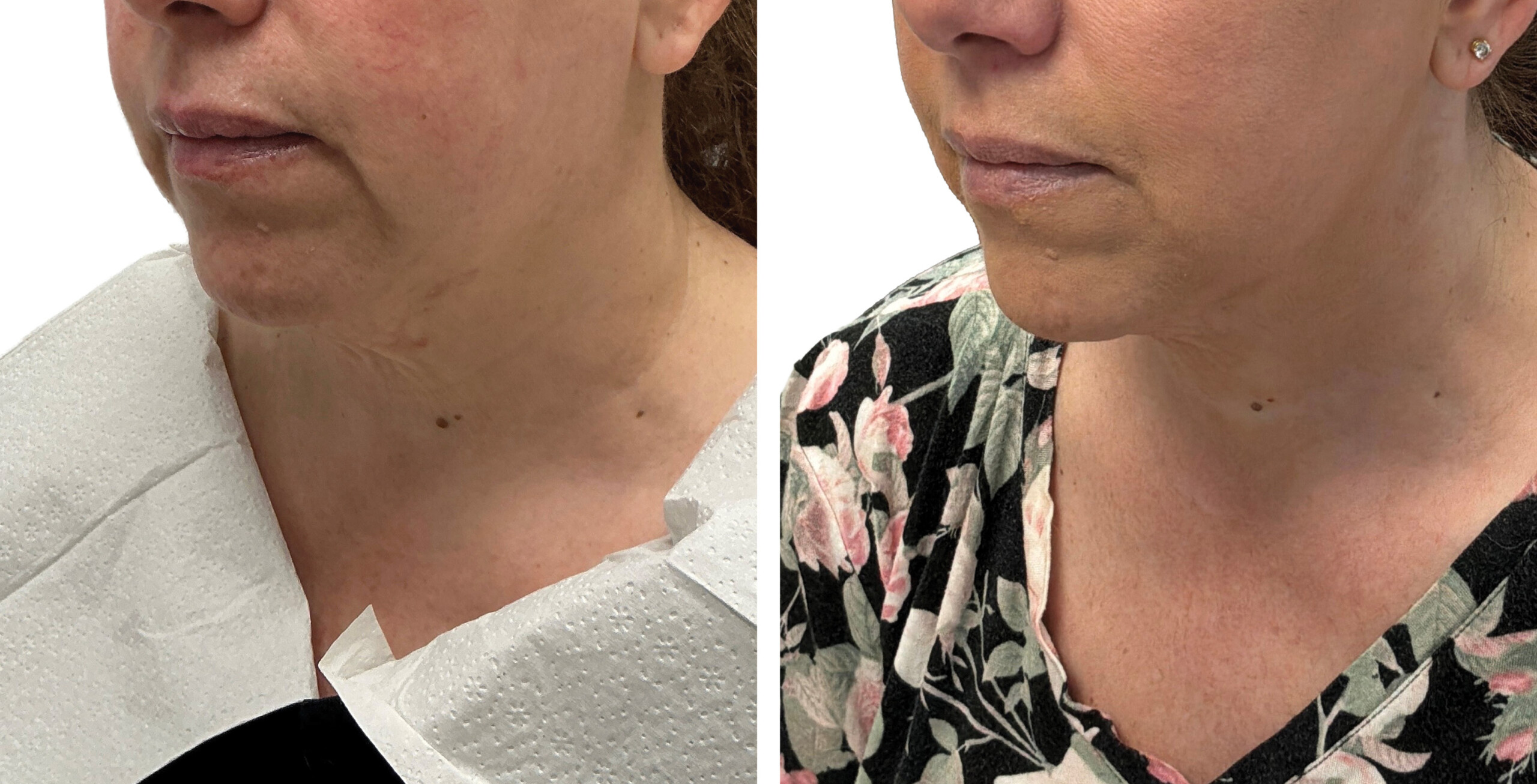 Ultherapy Prime before and after showing firmer-looking skin around the lower face and neck