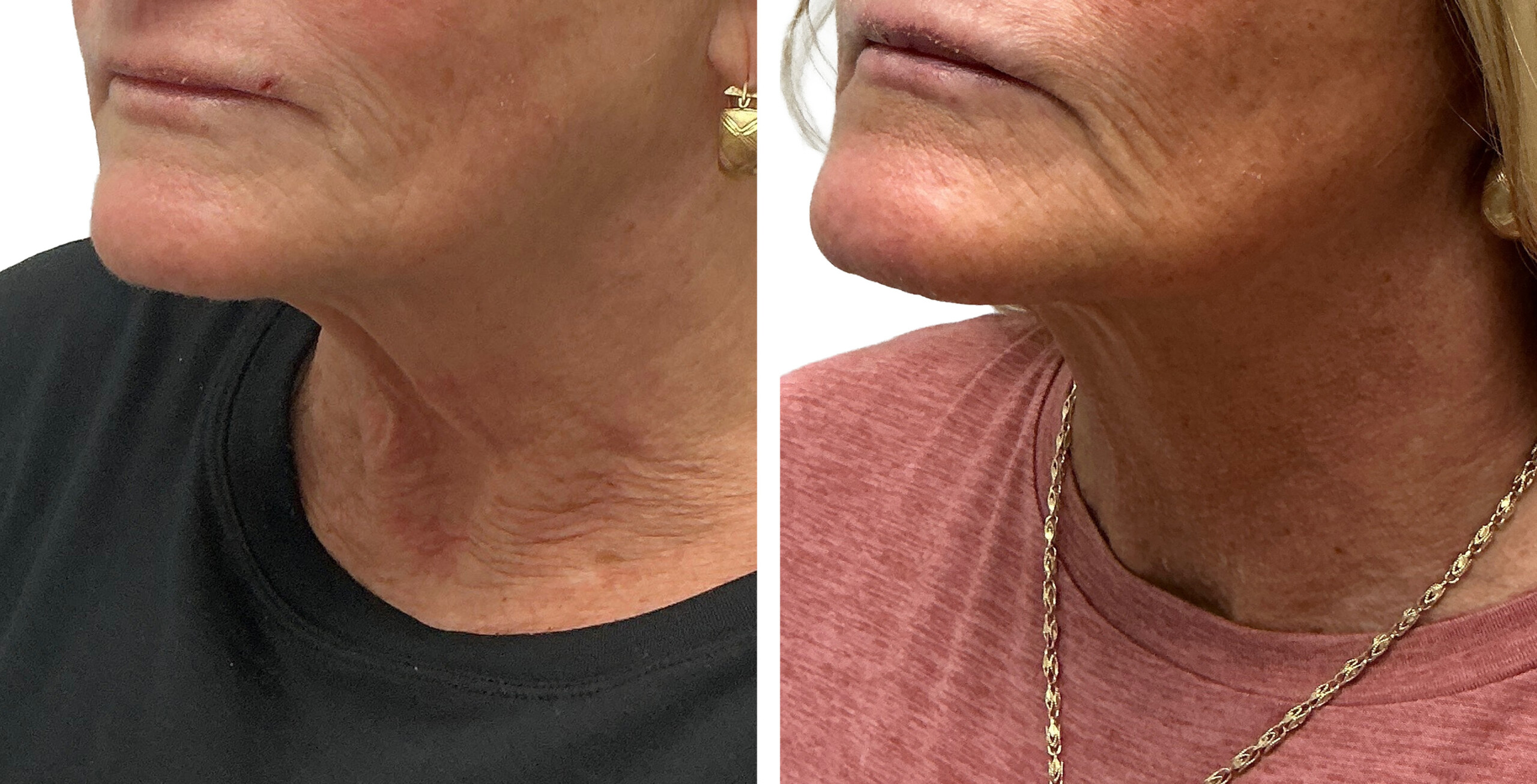 Before and after Ultherapy treatment showing the lower face and neck from a front angle