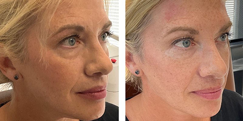 Before and After: Undereye Fillers