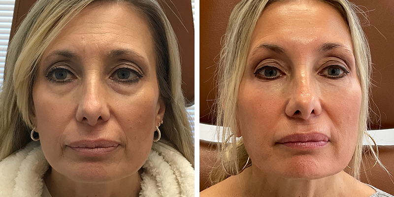Before and After: Undereye Fillers