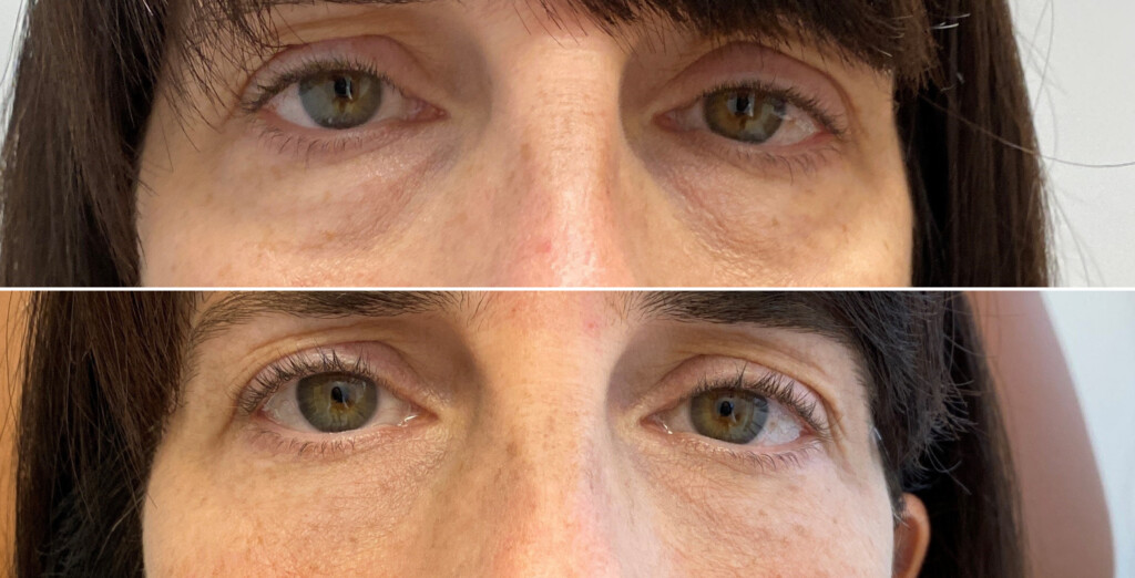Undereye filler before and after case