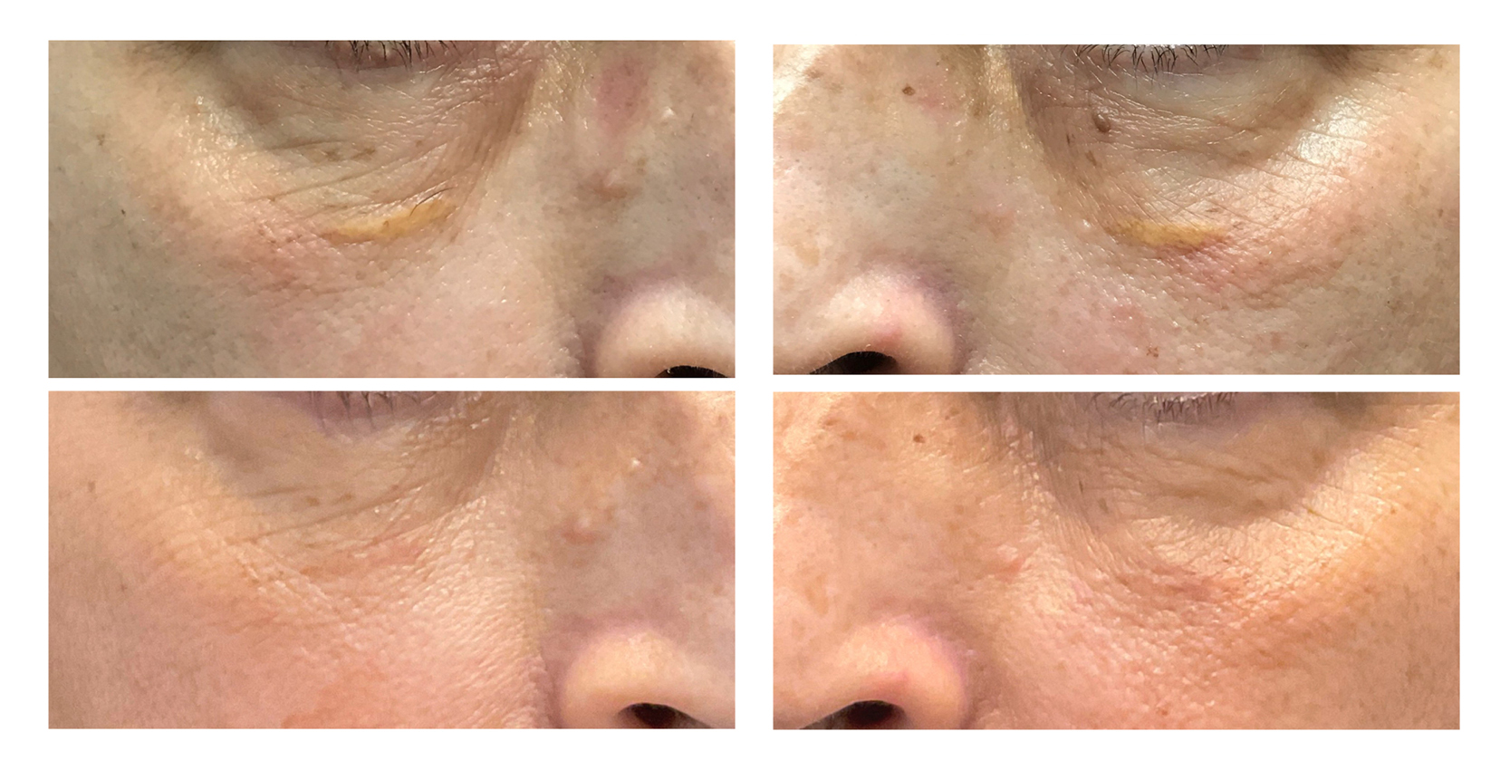 before and after Xanthelasma