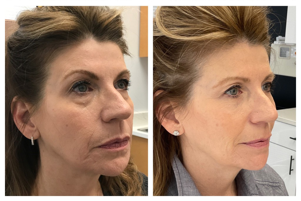 before and after of cosmetic treatments stacked fillers micro rf botox