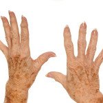 two hands with freckles and age spotting