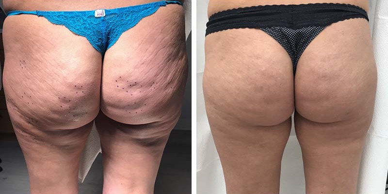 Before and After: Cellulite/Stretch Mark Treatment