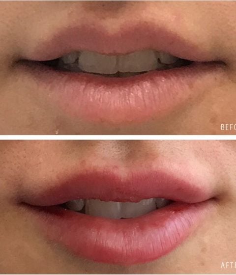 A before-and-after close-up of a woman’s lips showing a fuller, more defined appearance after lip filler treatment. The words before and after appear on the images.
