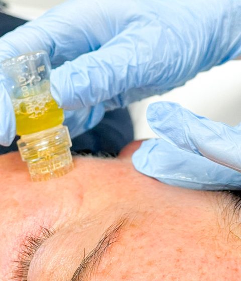Woman Getting Aquagold applied to her Face