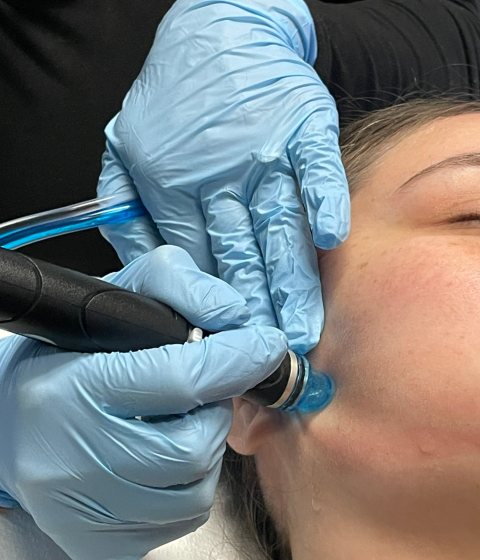 Close‑up of Sam performing a Platinum Hydrafacial on a patient’s cheek at Simply Dermatology, using a blue‑tipped wand.
