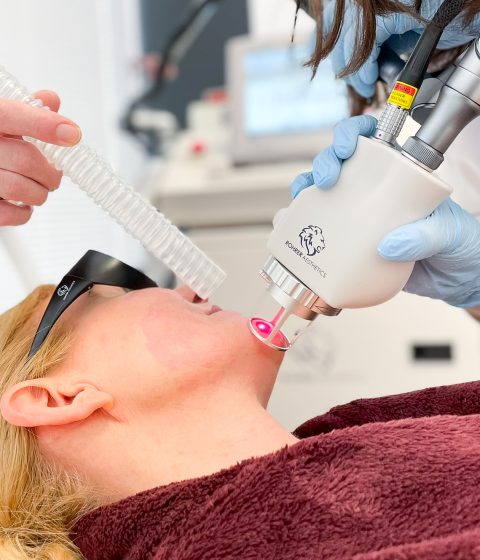 A provider performs fractional CO2 laser resurfacing on a patient’s cheek while an assistant holds a smoke evacuator nearby.