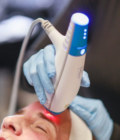 Clear + Brilliant fractional laser treatment being performed on a patient’s forehead at Simply Dermatology in Melville, Long Island.