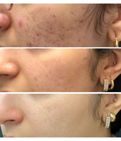 Before and after progression of acne treatments.