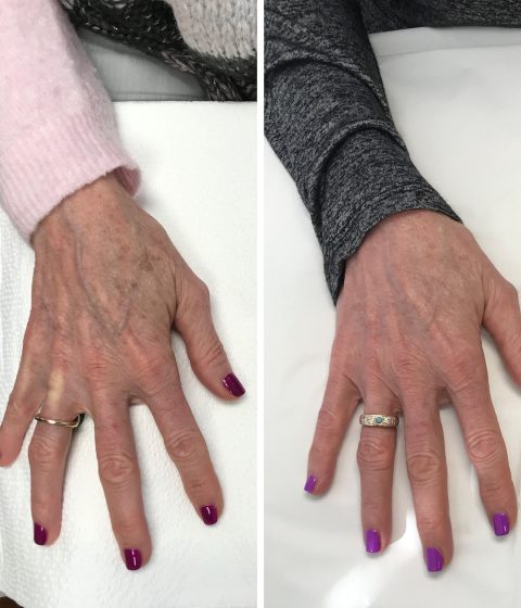 Before and after comparison of aging hands, showing improved skin texture and reduced prominence of spots from a Q Switch Treatment.