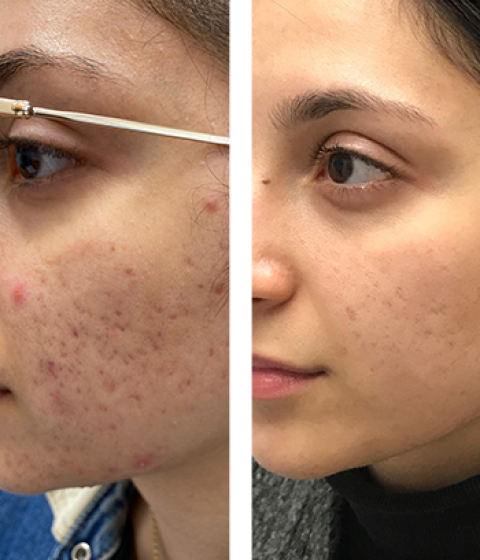 Complexion Wrinkles, Pores and Acne Scars Procedure Results