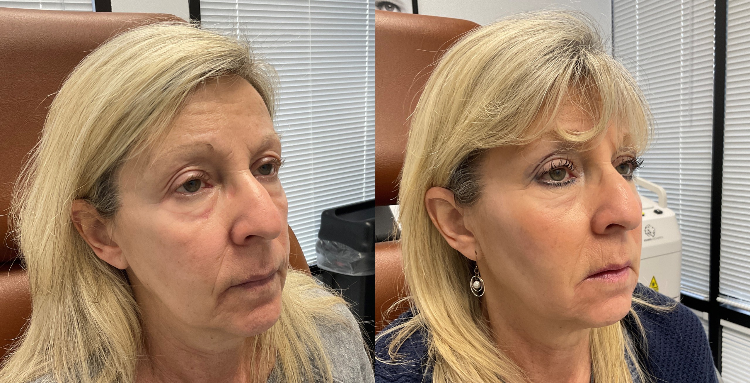 undereye filler before and after