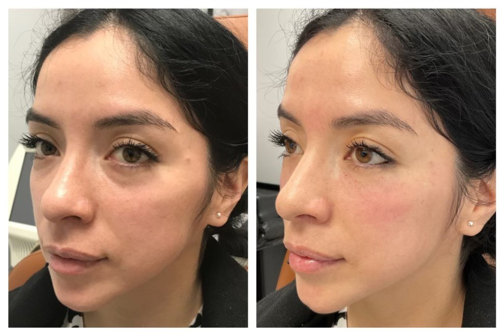 juvederm filler special promotion full face before and after