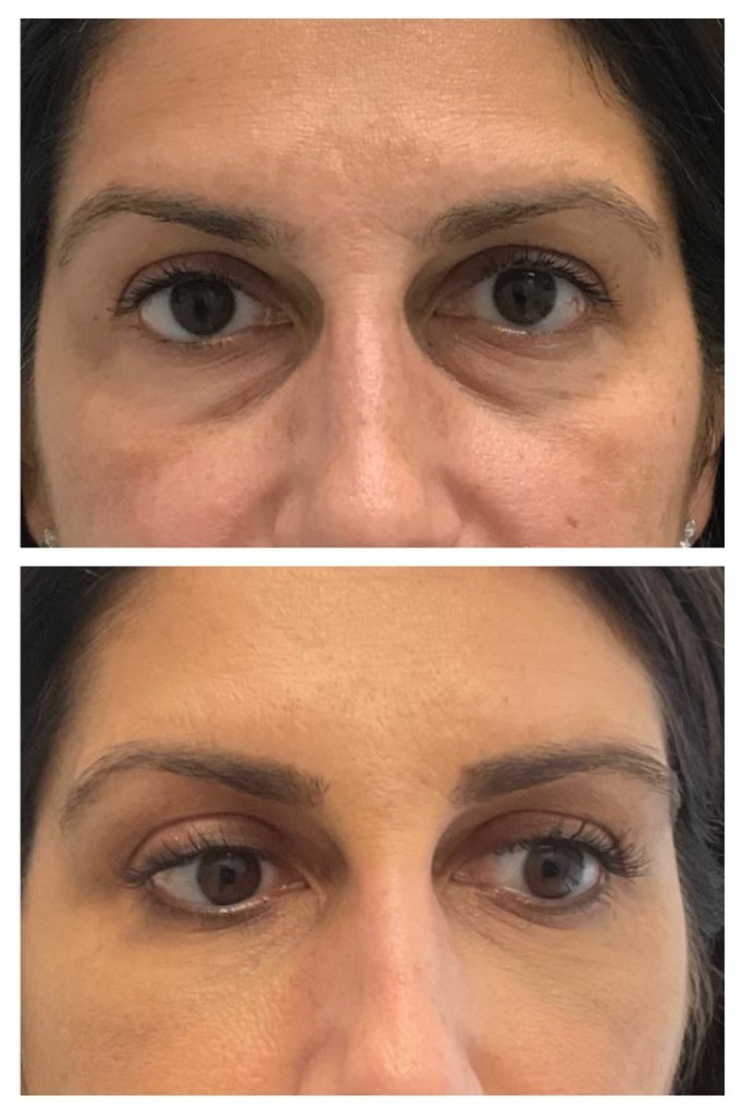juvederm filler special promotion under eyea before and after