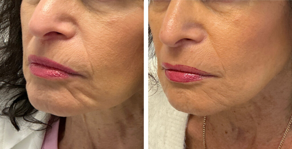 Before and after dermal filler treatment showing improved lower face volume and smoother lines around the mouth and chin