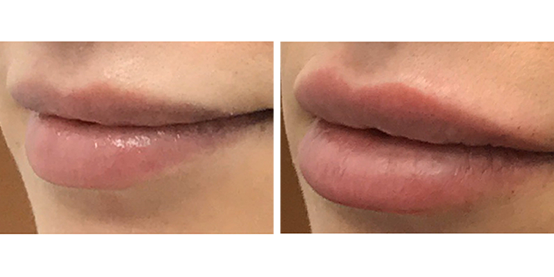 Before and After: Lip Filler