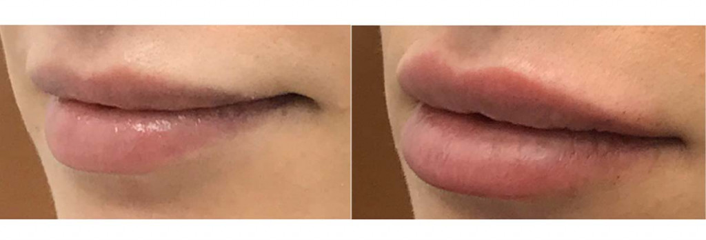 Before and After: Lip Fillers
