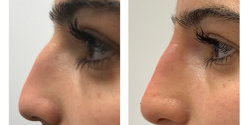 Before and After: Non surgical Rhinoplasty