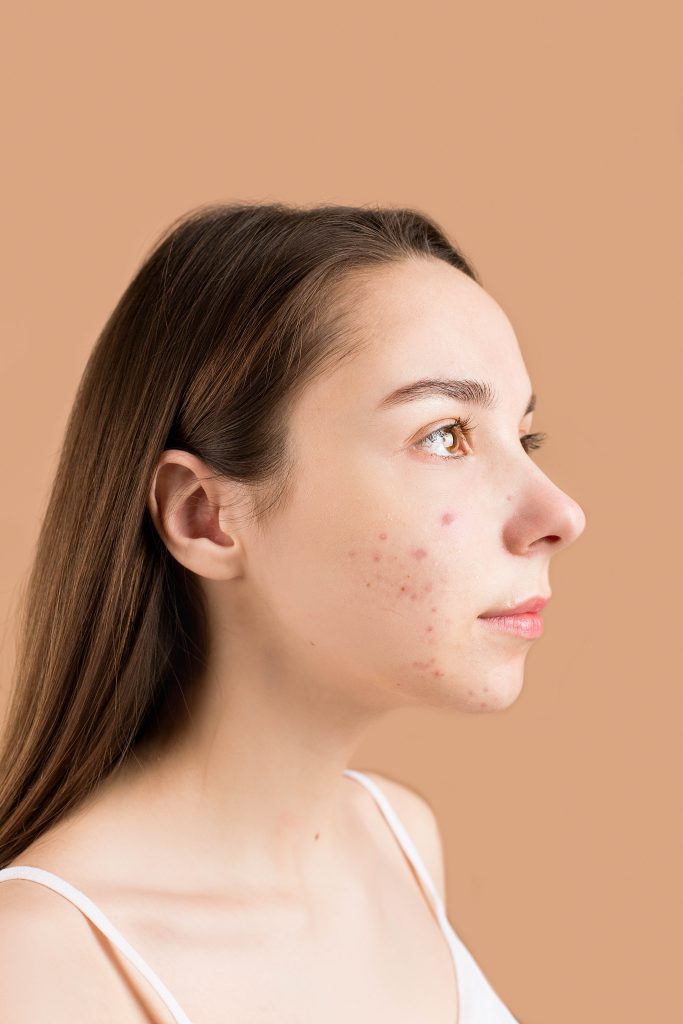 accutane for acne treatment teenage girl