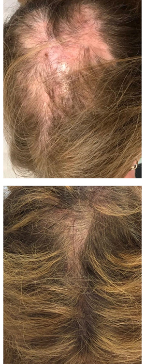 prp hair loss restoration before and after