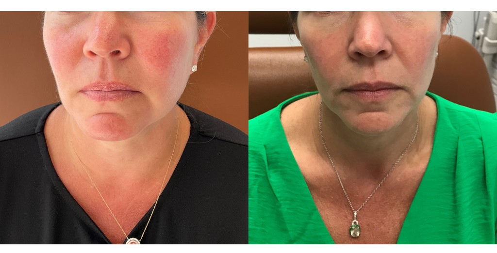 vbeam for rosacea before and after