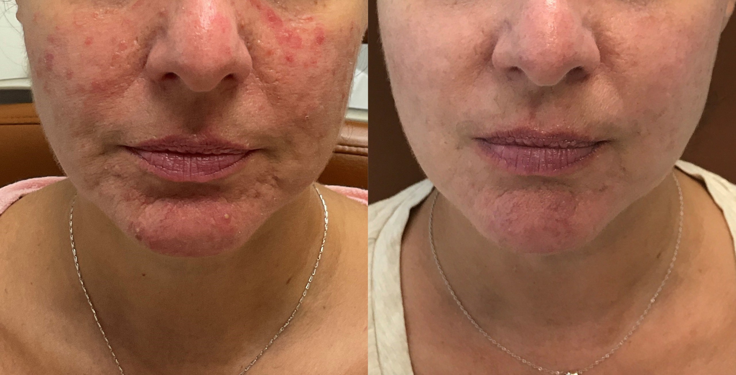 Rosacea treatment with holistic approach diet topical oral prescriptions