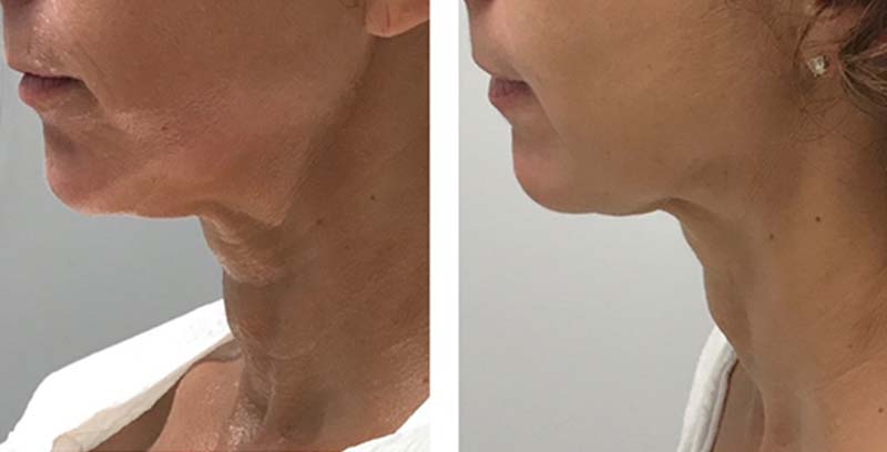 Ultherapy on Neck