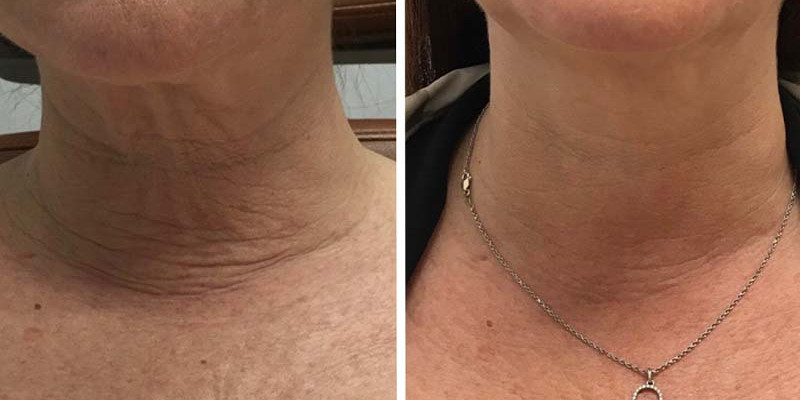 Ultherapy on Neck