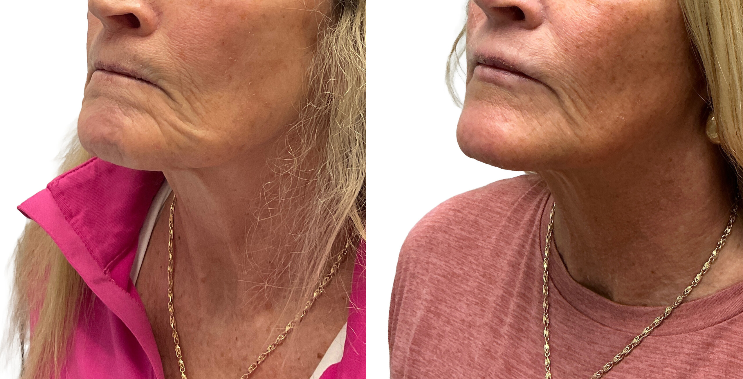 Before and after Ultherapy treatment of the lower face, jawline and neck from a front angle